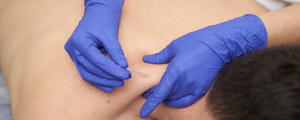 Punció seca aplicada per fisioterapeuta en tractament de dolor miofascial